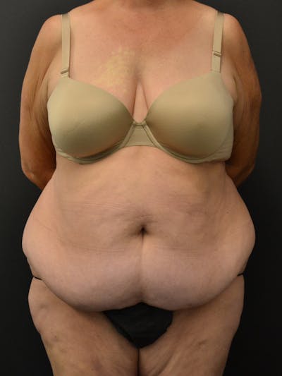 Tummy Tuck Before & After Gallery - Patient 220678 - Image 1