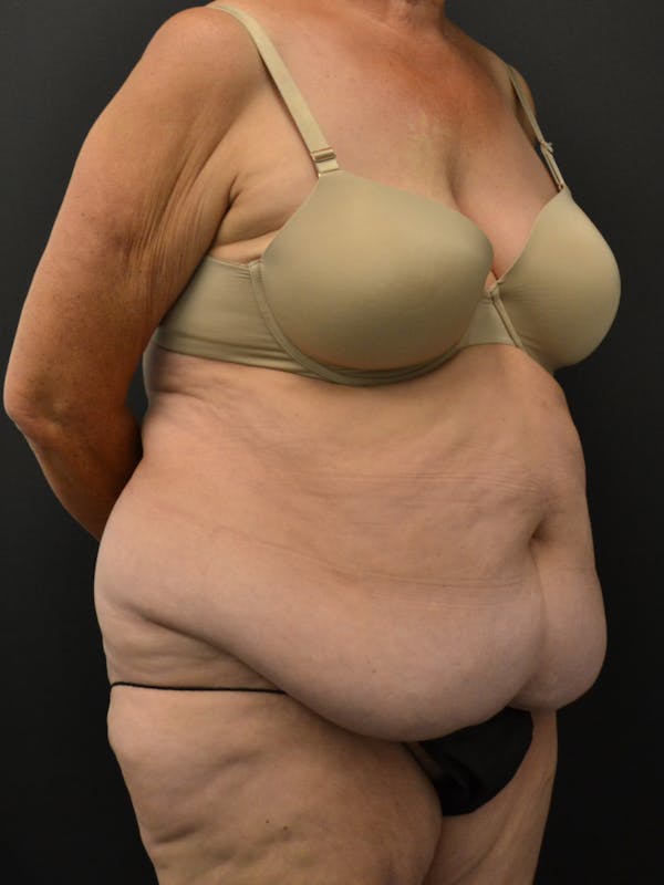 Tummy Tuck Before & After Gallery - Patient 220678 - Image 3