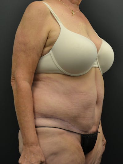 Tummy Tuck Before & After Gallery - Patient 220678 - Image 4