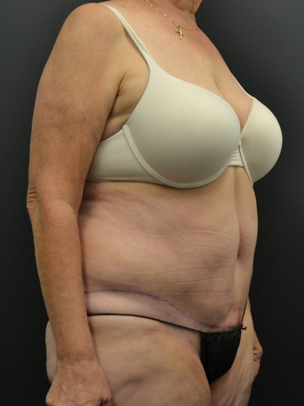 Tummy Tuck Before & After Gallery - Patient 220678 - Image 4
