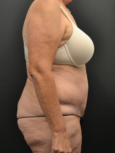Tummy Tuck Before & After Gallery - Patient 220678 - Image 6