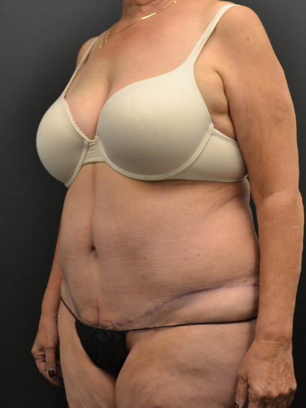 Tummy Tuck Before & After Gallery - Patient 220678 - Image 8