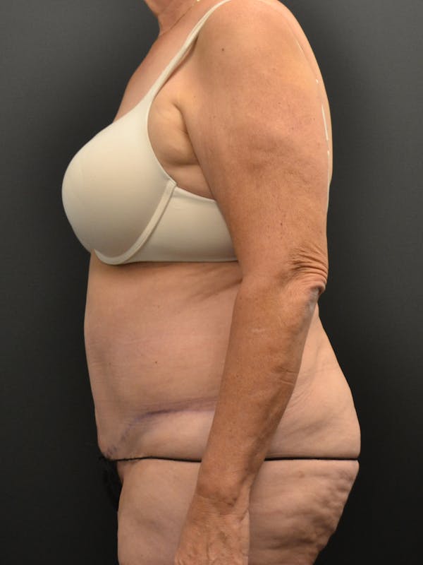 Tummy Tuck Before & After Gallery - Patient 220678 - Image 10