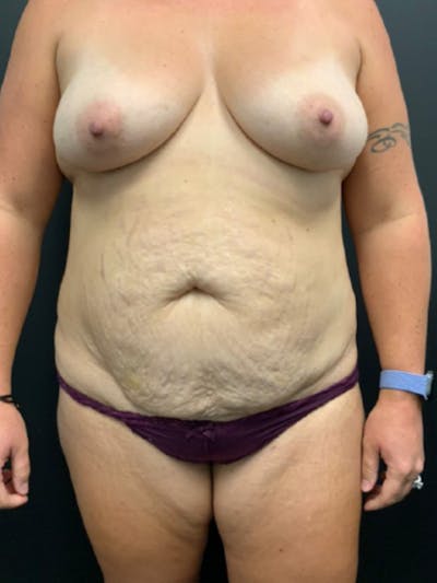 Mommy Makeover Before & After Gallery - Patient 981203 - Image 1
