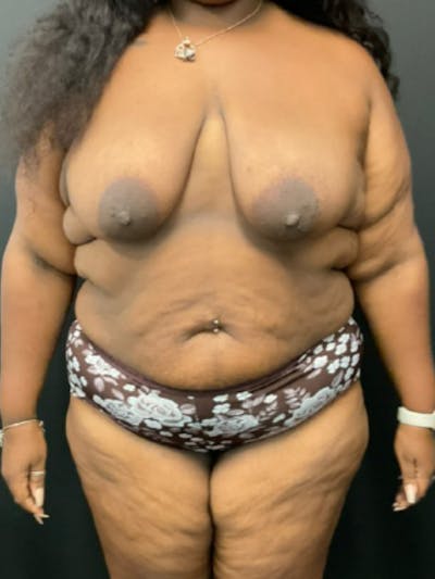 Mommy Makeover Before & After Gallery - Patient 117907 - Image 1