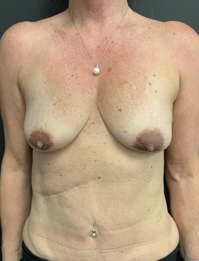 Mastopexy Before & After Gallery - Patient 400784 - Image 1