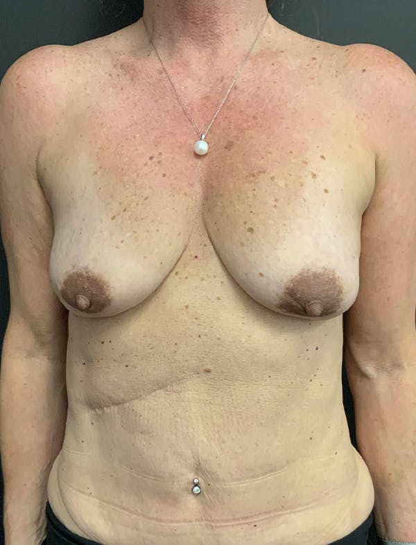 Mastopexy Before & After Gallery - Patient 400784 - Image 1