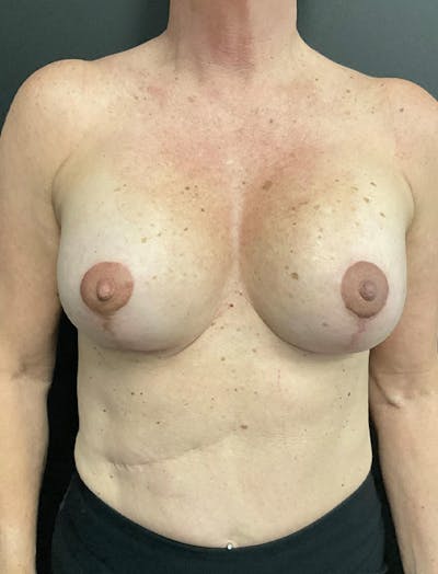 Mastopexy Before & After Gallery - Patient 400784 - Image 2