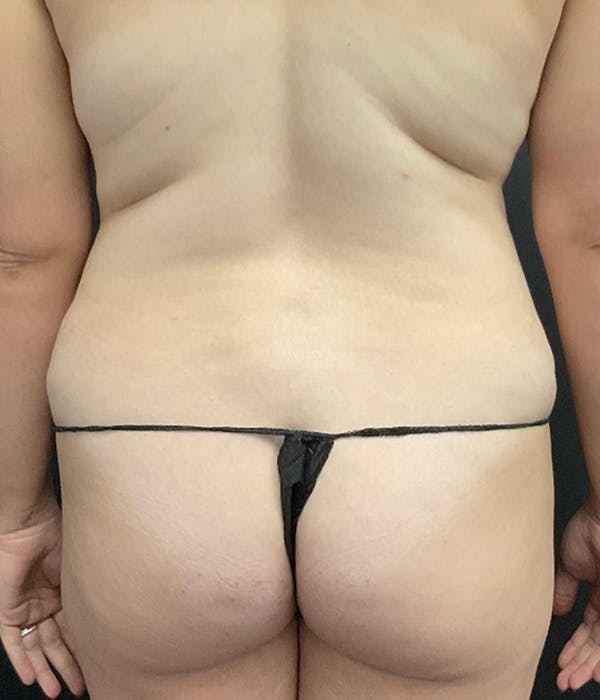 Fat Grafting Before & After Gallery - Patient 139454 - Image 1