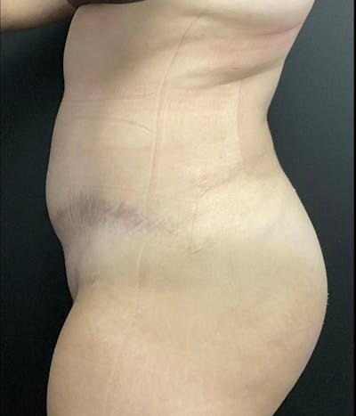Fat Grafting Before & After Gallery - Patient 139454 - Image 6