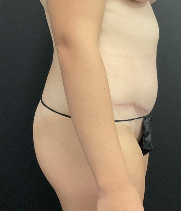 Fat Grafting Before & After Gallery - Patient 139454 - Image 3