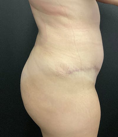 Fat Grafting Before & After Gallery - Patient 139454 - Image 4