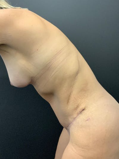 Mommy Makeover Before & After Gallery - Patient 714575 - Image 6
