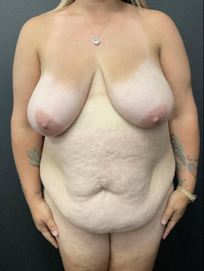 Tummy Tuck Before & After Gallery - Patient 414902 - Image 1