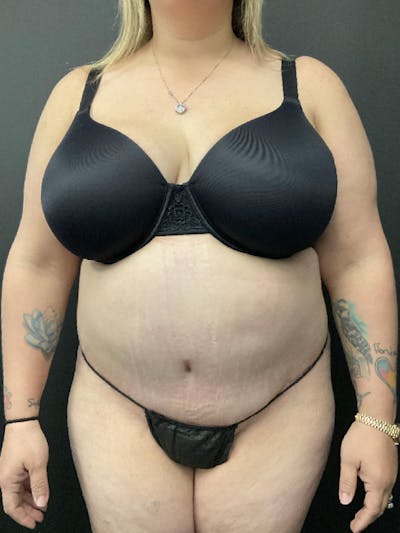 Tummy Tuck Before & After Gallery - Patient 414902 - Image 2