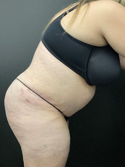 Tummy Tuck Before & After Gallery - Patient 414902 - Image 4