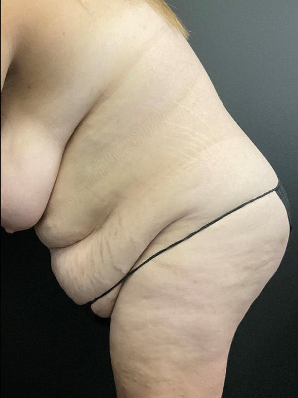 Tummy Tuck Before & After Gallery - Patient 414902 - Image 5