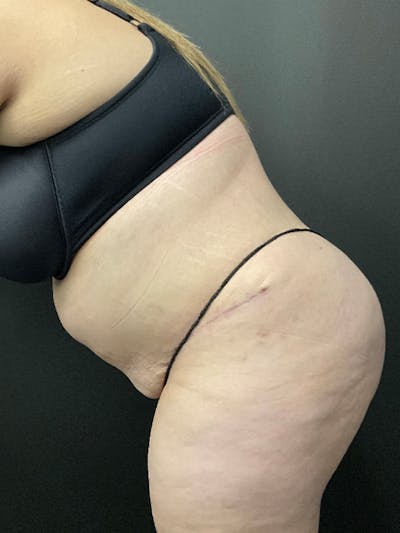 Tummy Tuck Before & After Gallery - Patient 414902 - Image 6