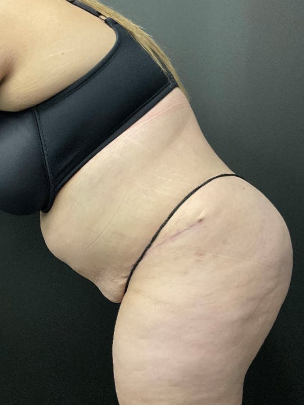 Tummy Tuck Before & After Gallery - Patient 414902 - Image 6
