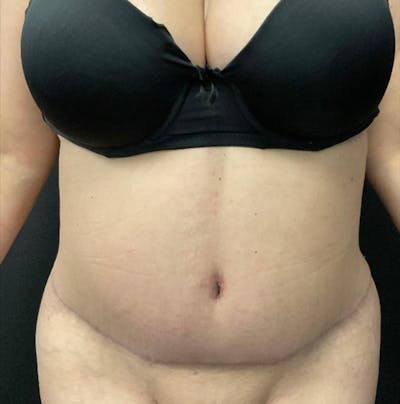 Tummy Tuck Before & After Gallery - Patient 167462 - Image 2