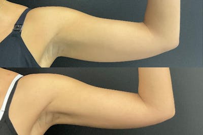 Brachioplasty Before & After Gallery - Patient 482210 - Image 1