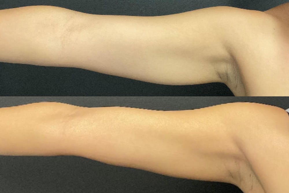 Brachioplasty Before & After Gallery - Patient 482210 - Image 3