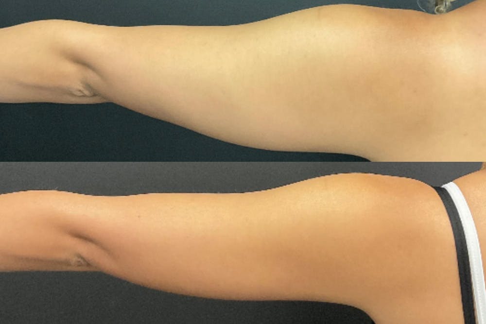 Brachioplasty Before & After Gallery - Patient 482210 - Image 2
