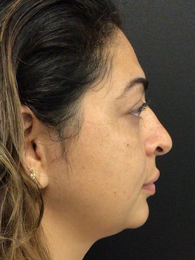 Rhinoplasty Before & After Gallery - Patient 397029 - Image 1