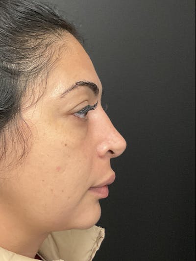 Rhinoplasty Before & After Gallery - Patient 397029 - Image 2