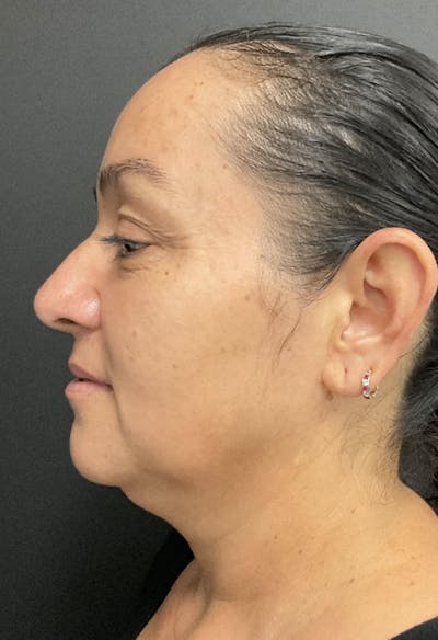 Submental Liposuction Before & After Gallery - Patient 181431 - Image 1