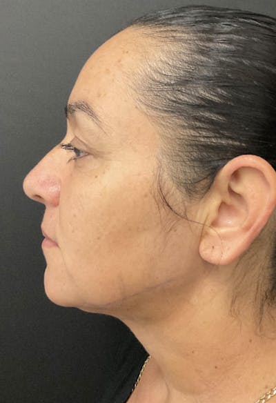 Submental Liposuction Before & After Gallery - Patient 181431 - Image 2