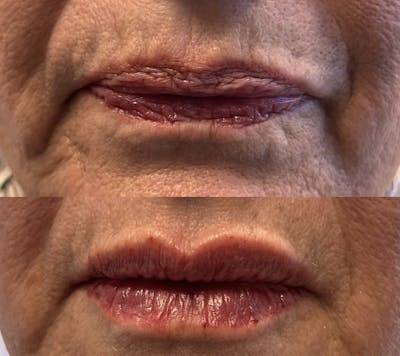 Lip Fillers Before & After Gallery - Patient 624337 - Image 1