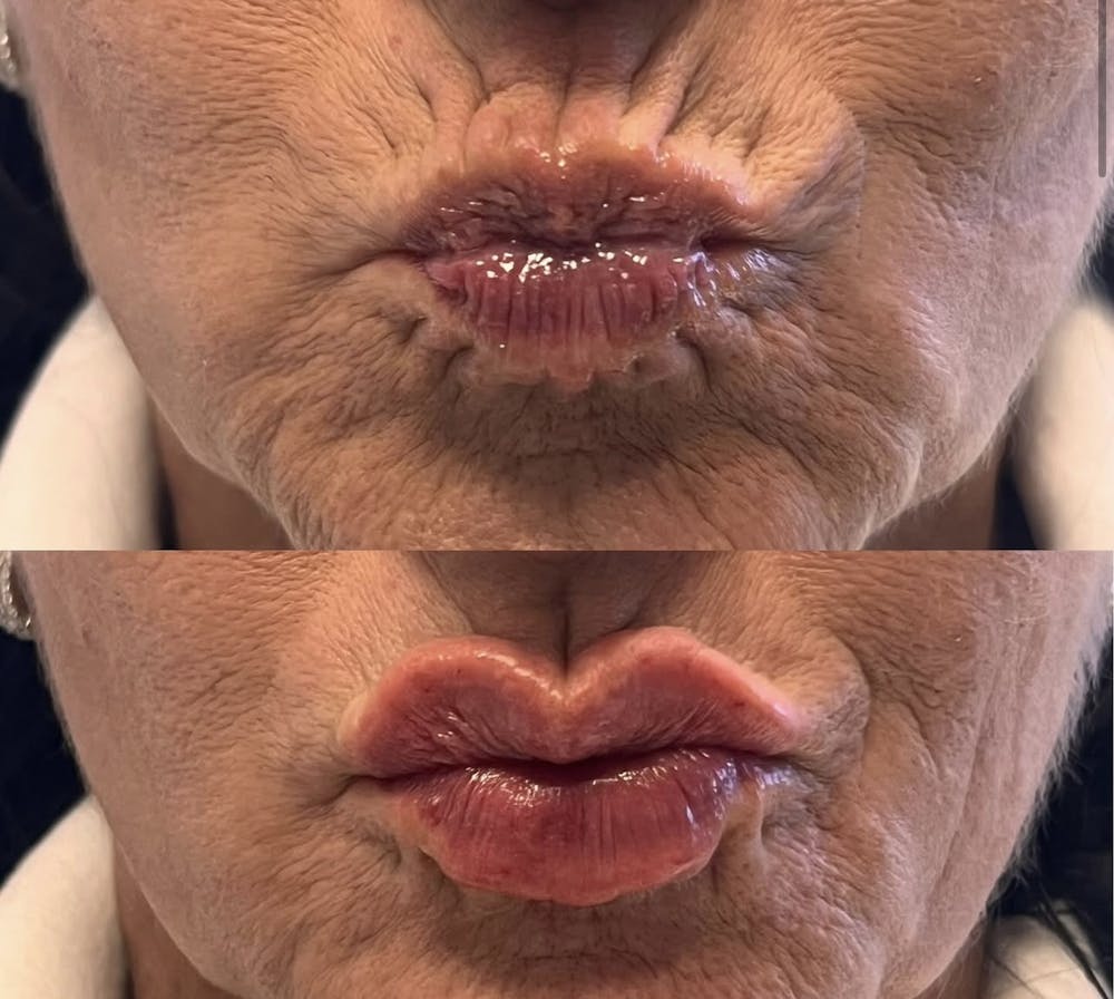 Lip Fillers Before & After Gallery - Patient 381094 - Image 1