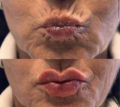 Lip Fillers Before & After Gallery - Patient 381094 - Image 1