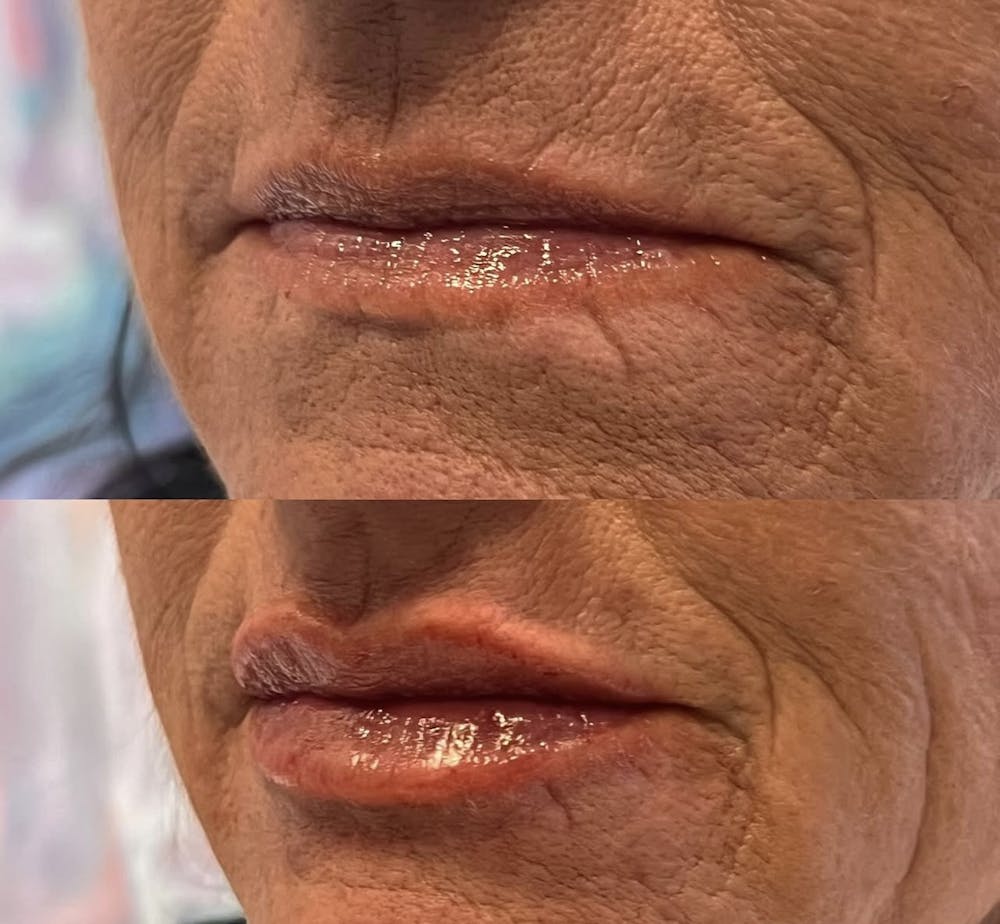 Lip Fillers Before & After Gallery - Patient 147260 - Image 1