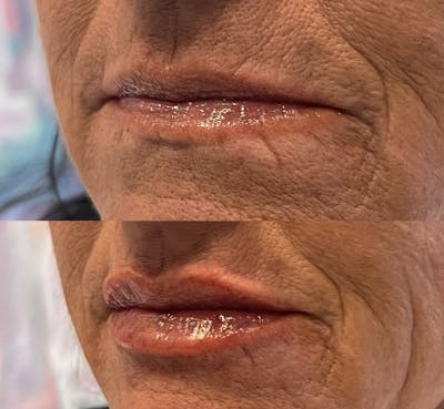 Lip Fillers Before & After Gallery - Patient 147260 - Image 1