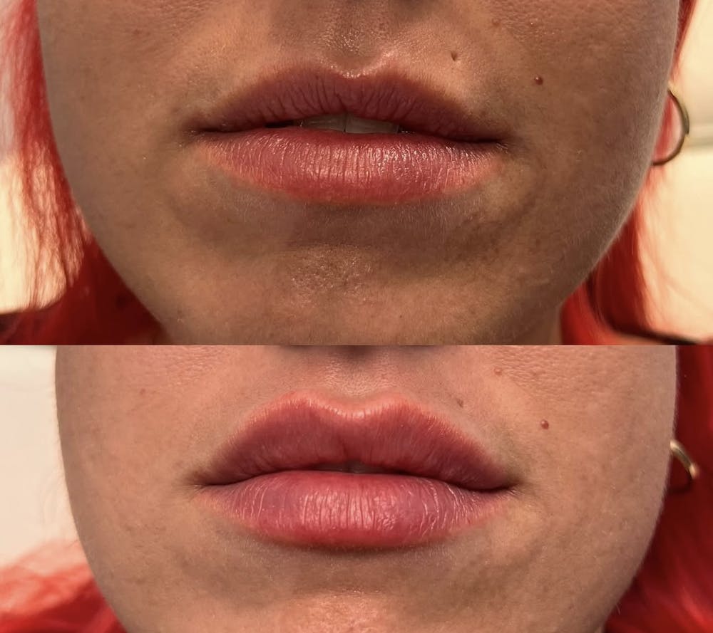 Lip Fillers Before & After Gallery - Patient 226977 - Image 1