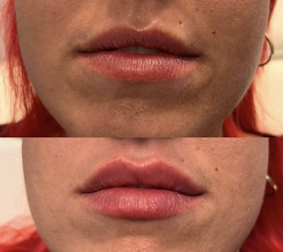 Lip Fillers Before & After Gallery - Patient 226977 - Image 1