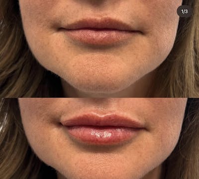 Lip Fillers Before & After Gallery - Patient 748500 - Image 1