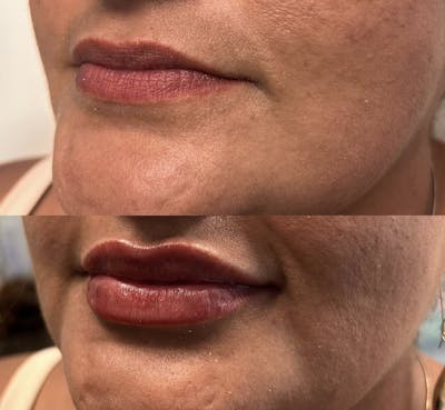 Lip Fillers Before & After Gallery - Patient 896378 - Image 1