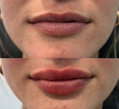 Lip Fillers Before & After Gallery - Patient 277697 - Image 1