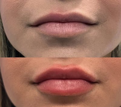 Lip Fillers Before & After Gallery - Patient 164712 - Image 1