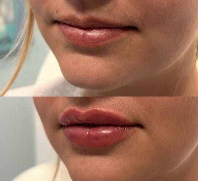 Lip Fillers Before & After Gallery - Patient 340512 - Image 1