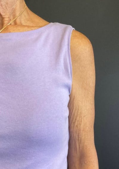 Sofwave Before & After Gallery - Patient 108777 - Image 1