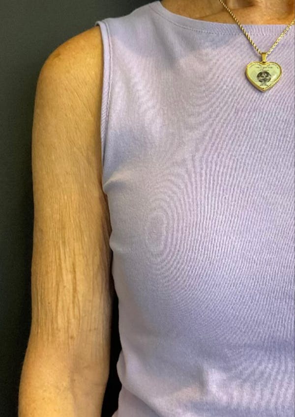 Sofwave Before & After Gallery - Patient 108777 - Image 3