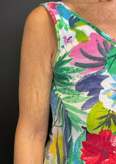 Sofwave Before & After Gallery - Patient 108777 - Image 4
