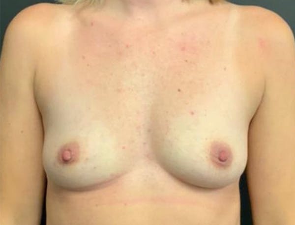 Breast Augmentation Before & After Gallery - Patient 428086 - Image 1