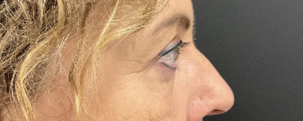 Blepharoplasty Before & After Gallery - Patient 308814 - Image 4