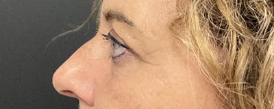Blepharoplasty Before & After Gallery - Patient 308814 - Image 6