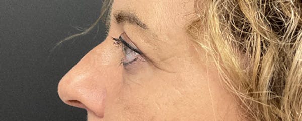 Blepharoplasty Before & After Gallery - Patient 308814 - Image 6